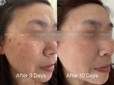 IPL PhotoFacial for Face or Neck - SkinVital Studio