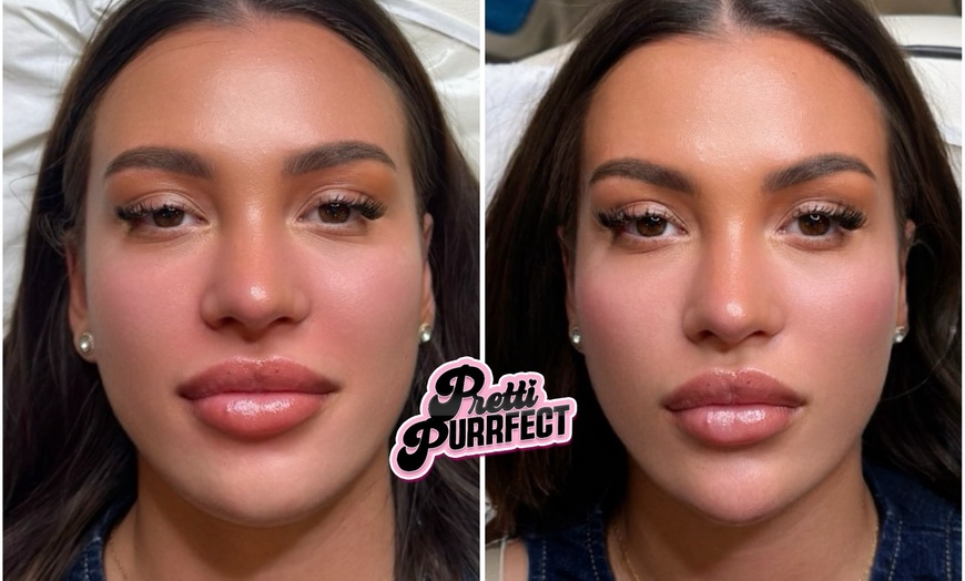 Image 9: Up to 68% Off on Injection - Dermal Filler at Pretti Purrfect