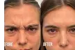 Up to 53% Off on Injection - Botox at Nude Aesthetics - Second Medium