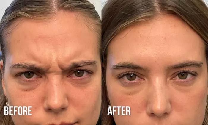 Refreshed Look with 20 or 40 Units of Botox 