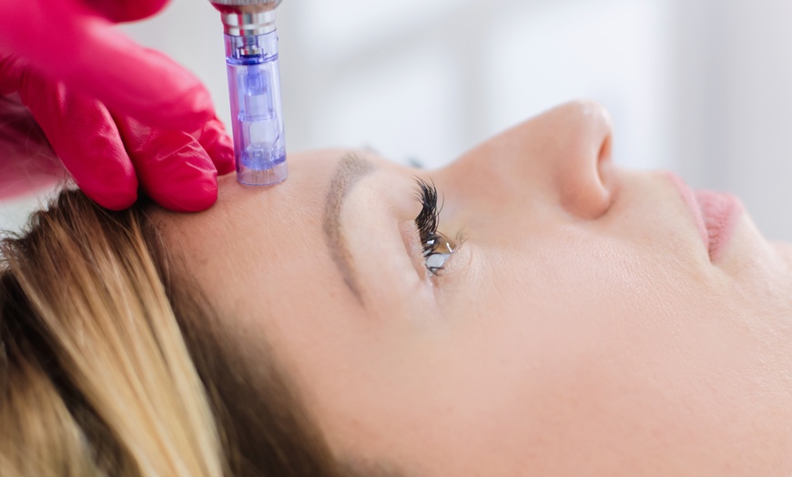 Image 7: Kosmetisches Microneedling und Diamant-Mikrodermabrasion für 1 Person