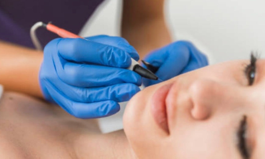 Image 3: Up to 30% Off on Electrolysis at Lasting Lines