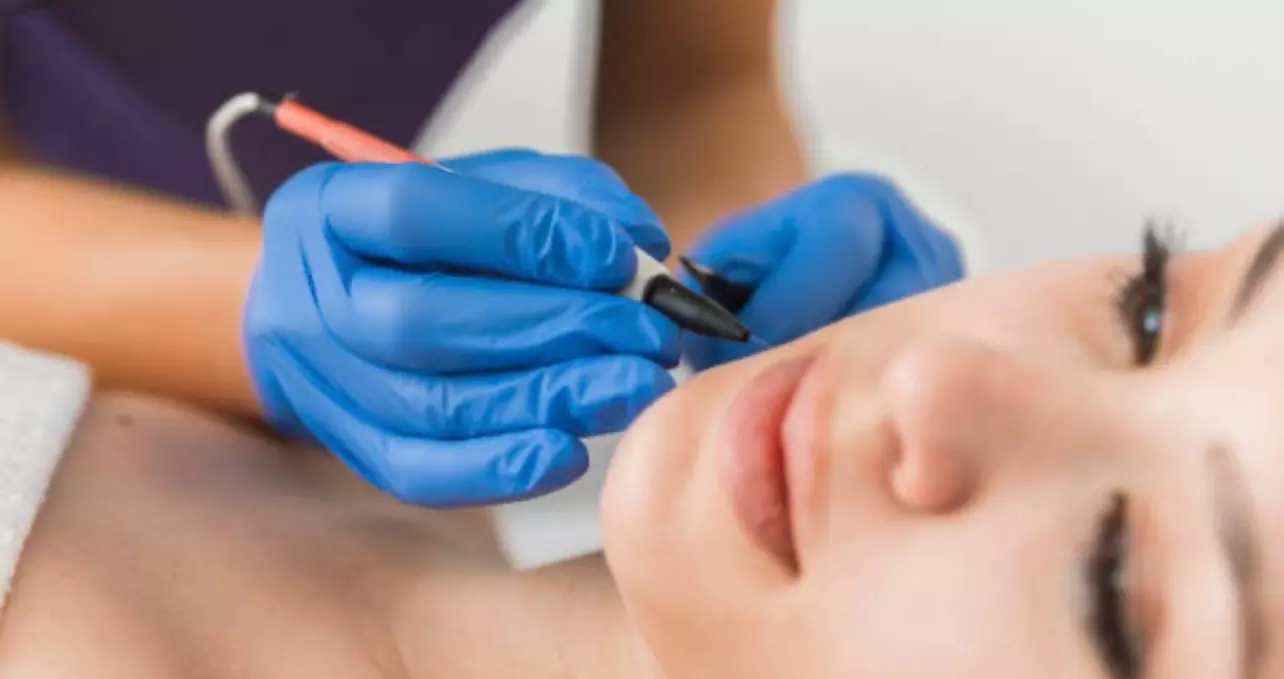 Up to 30% Off on Electrolysis at Lasting Lines