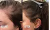 Up to 67% Off on Hair Restoration - Non-Surgical at Nude Aesthetics