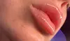 Up to 43% Off on Lip Enhancement at AB Botox Queen