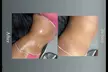 Targeted Fat Reduction – Non-Invasive Laser Lipo Session (Up to 50% Off) at Brilluxe Med Spa - Second Medium