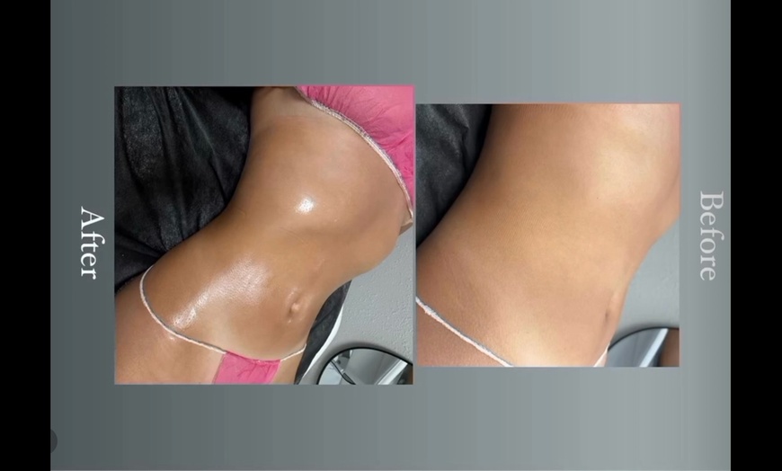 Image 4: Targeted Fat Reduction – Non-Invasive Laser Lipo Session