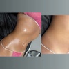 Image 4: Targeted Fat Reduction – Non-Invasive Laser Lipo Session