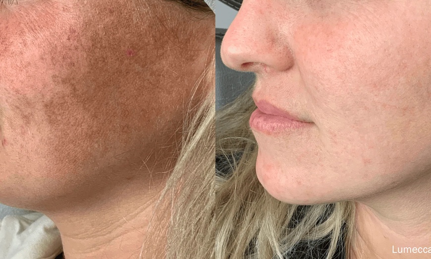 Image 4: Get Radiant Skin with 1, 2, or 3 IPL Sessions - 10 Minutes Per Session