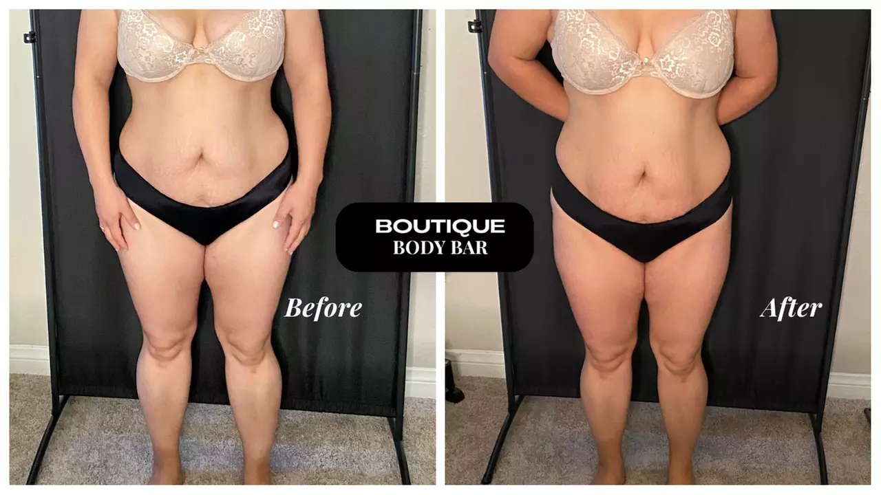 Transform Your Body: Ultrasonic Cavitation Session