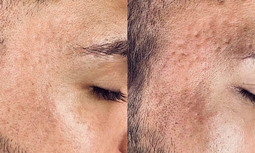 Image 3: Micro-needling with LED Light Therapy to Improve Skin Texture
