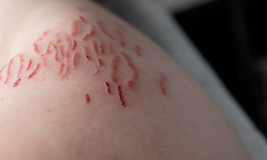 Image 2: Transform Your Skin with Targeted Stretch Mark Revision or Removal