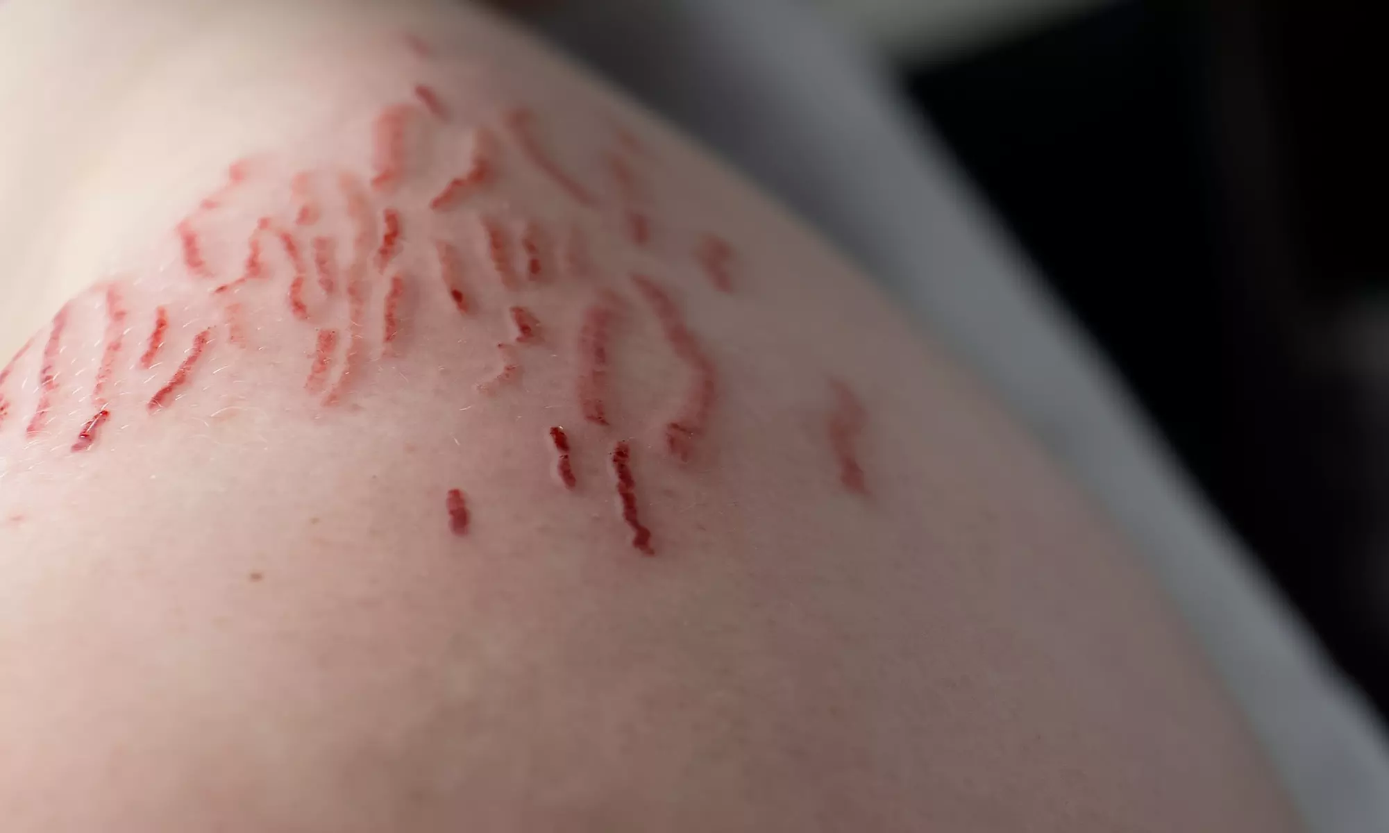 Transform Your Skin with Targeted Stretch Mark Revision or Removal