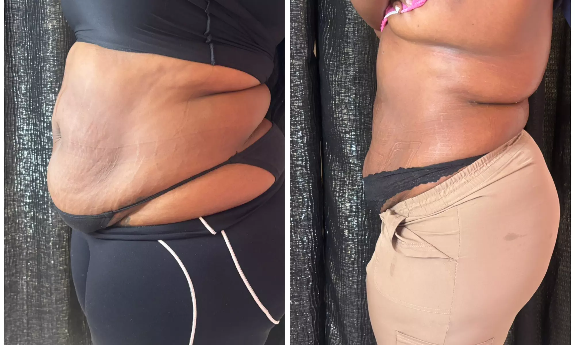 Up to 30% Off on Cavitation at Extreme body sculpting