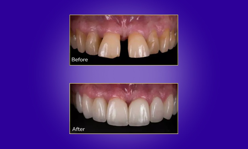 Image 5: Transform Your Smile with Custom Teeth Whitening