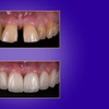 Image 5: Transform Your Smile with Custom Teeth Whitening