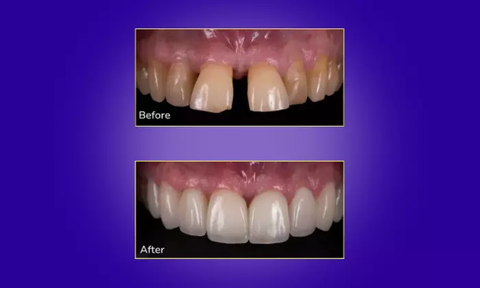 Transform Your Smile with Custom Teeth Whitening