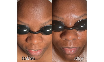 Microdermabrasion Exfoliating Facial with LED, Sonophoresis Infusion and Masque Upgrade - Oh my glow llc