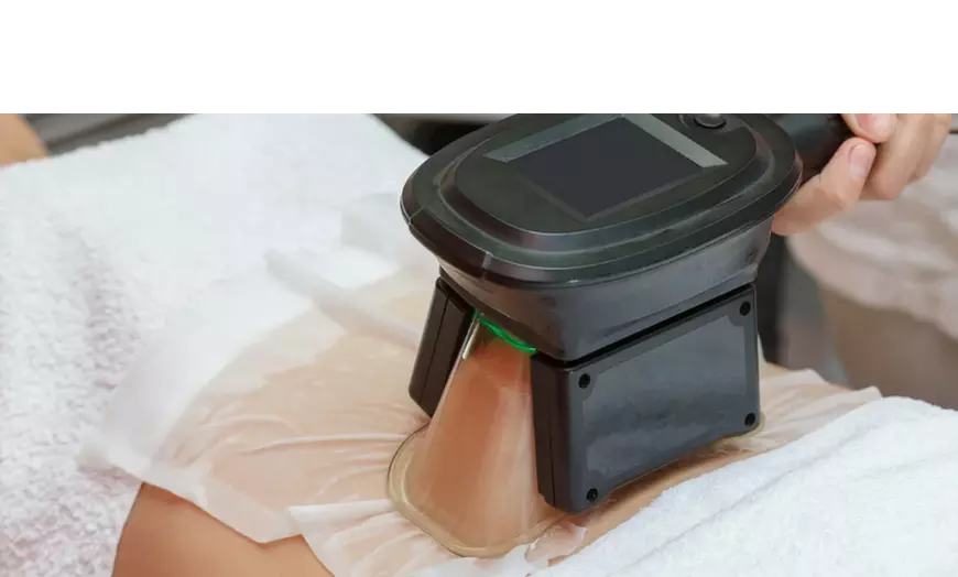 Image 1: Technologie die je leven makkelijker maakt: cryolipolyse behandeling