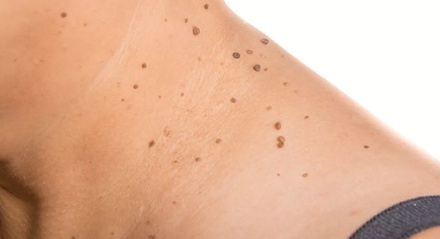 Removal of 2 skin tags - 2mm each - Beyond Esthetics