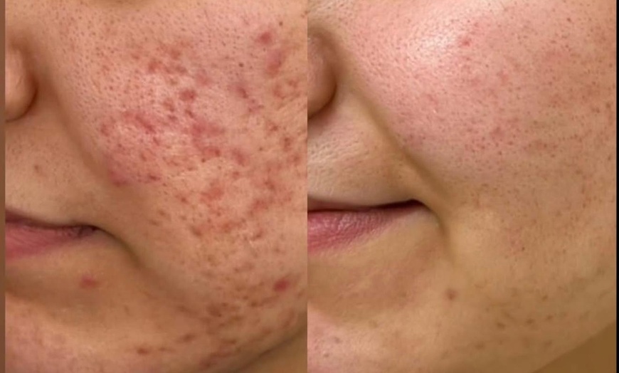Image 2: 1 or 2 CO2 Laser Skin Treatments on Eyelids, Face, Neck or Acne Scar