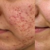 Image 2: 1 or 2 CO2 Laser Skin Treatments on Eyelids, Face, Neck or Acne Scar