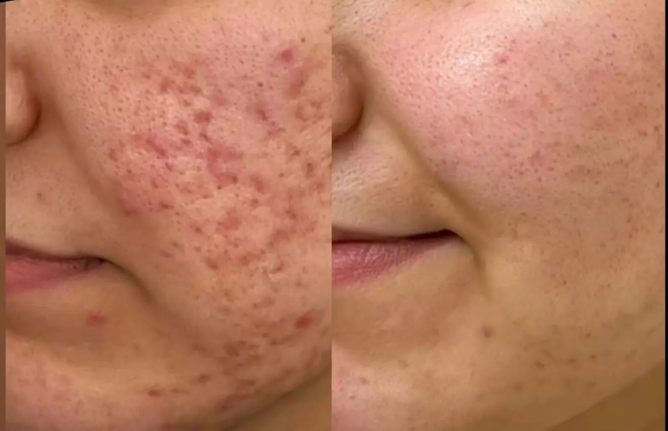 1 or 2 CO2 Laser Skin Treatments on Eyelids, Face, Neck or Acne Scar