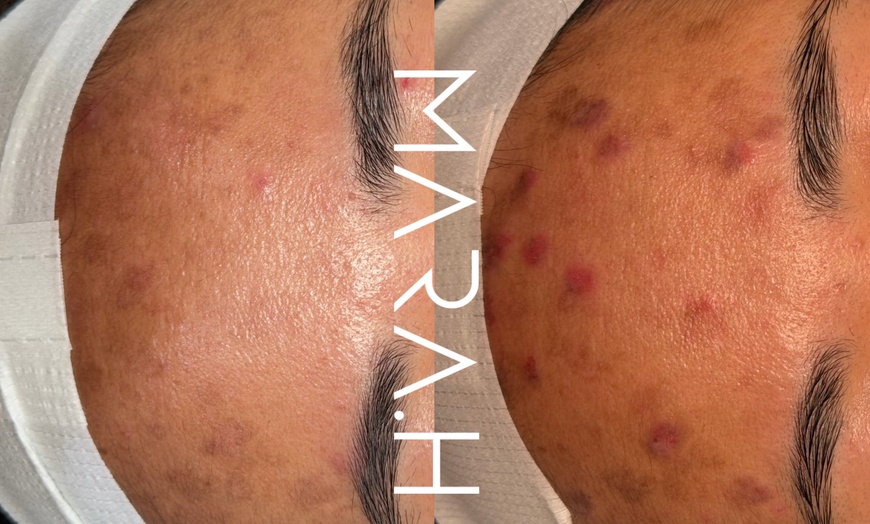 Image 2: 1 or 2 Sessions: Picosure-Pro Full Mode Pigmentation Reduction