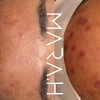 Image 2: 1 or 2 Sessions: Picosure-Pro Full Mode Pigmentation Reduction