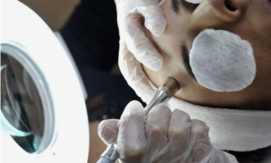 Image 3: One or Three Sessions of Diamond Dermabrasion Skin Peeling Sessions
