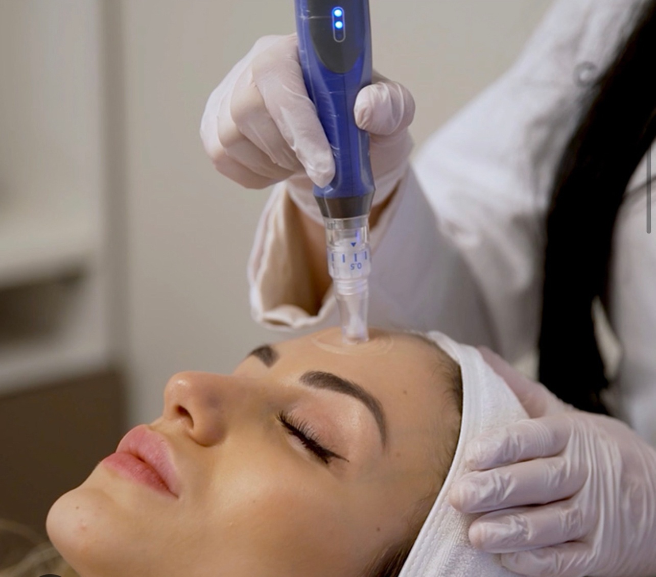 Refresh Your Skin with One Micro-Needling Treatment