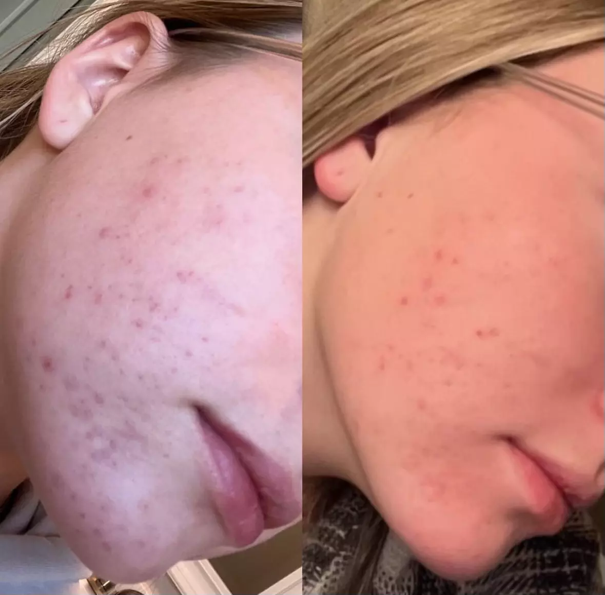 Up to 53% Off on Acne Treatment at Complexion Esthetician - Second Medium