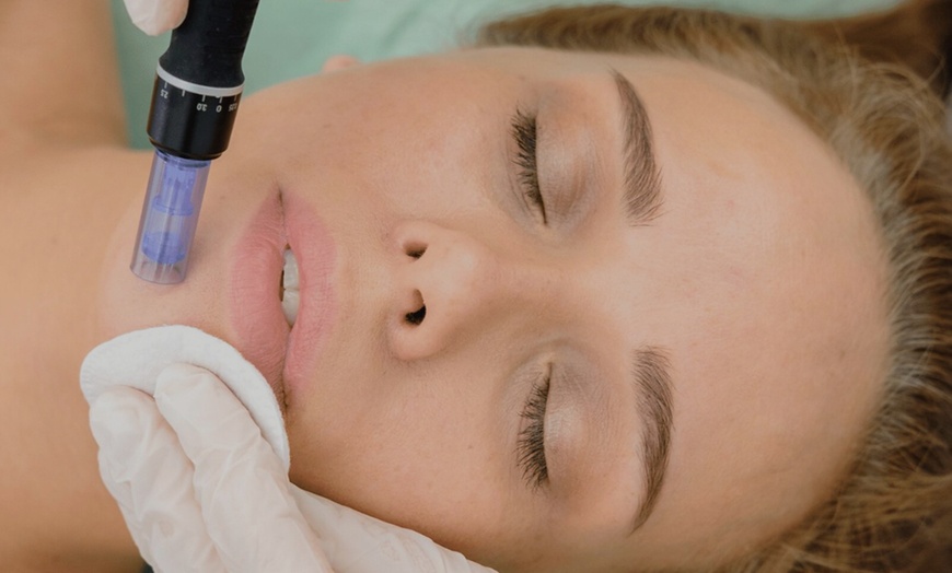 Image 1: Up to 58% Off on Micro-Needling at Refined Radiance Aesthetics, Westlake Village