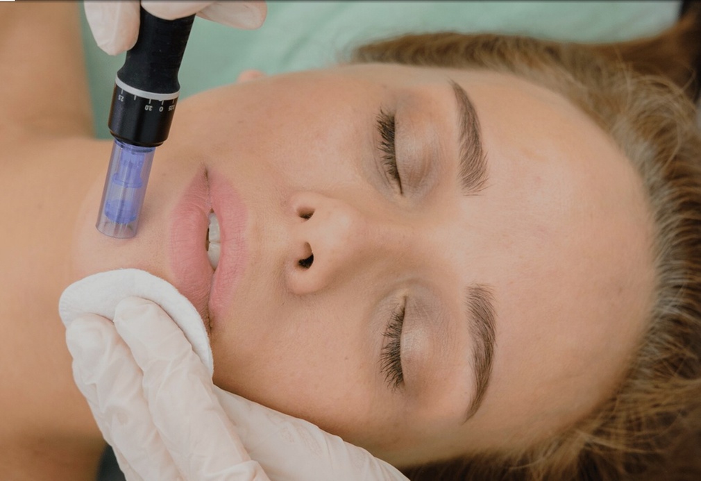 Up to 53% Off on Micro-Needling at Refined Radiance Aesthetics, Westlake Village