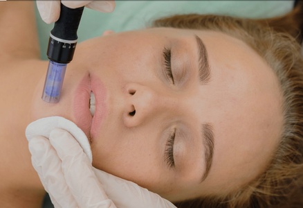 60 Min Micro-needling + LED Red Light Therapy - 1 Session - Refined Radiance Aesthetics, Westlake Village