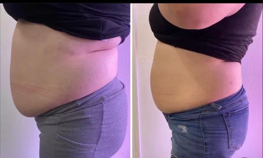 Image 4: Up to 62% Off on Fat Reduction - Non-Branded at Beauty By Bear