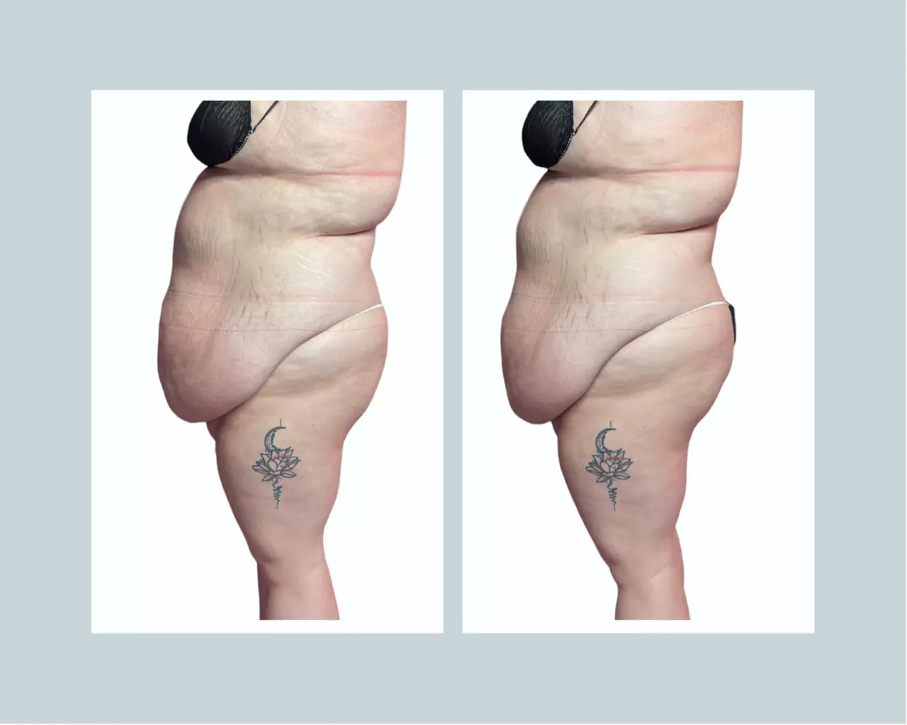 Up to 60% Off on Fat Reduction - Non-Branded at Beauty By Drea Renae - Primary Image