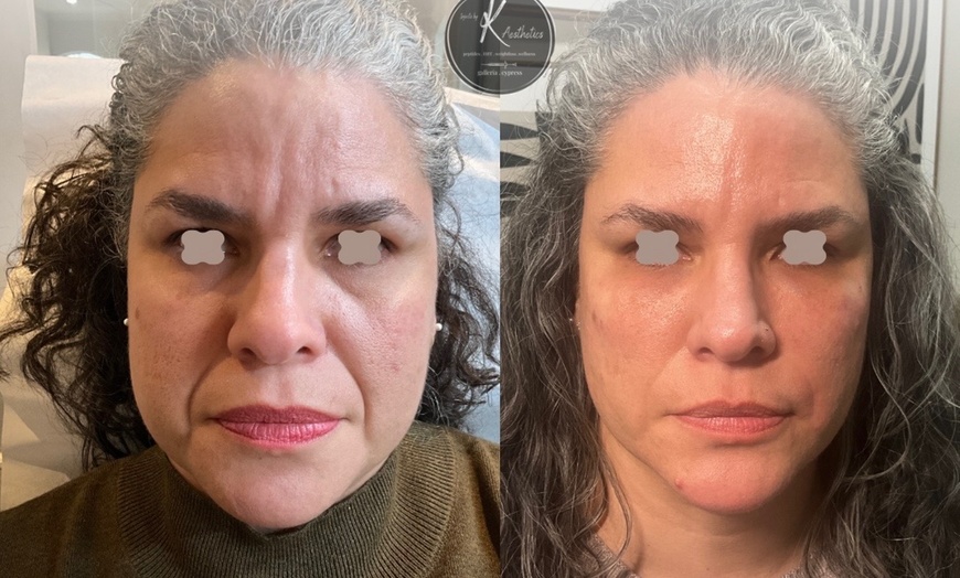 Image 4: PRF Under-Eye Rejuvenation & Organic EZ Gel Facial Balancing Sessions