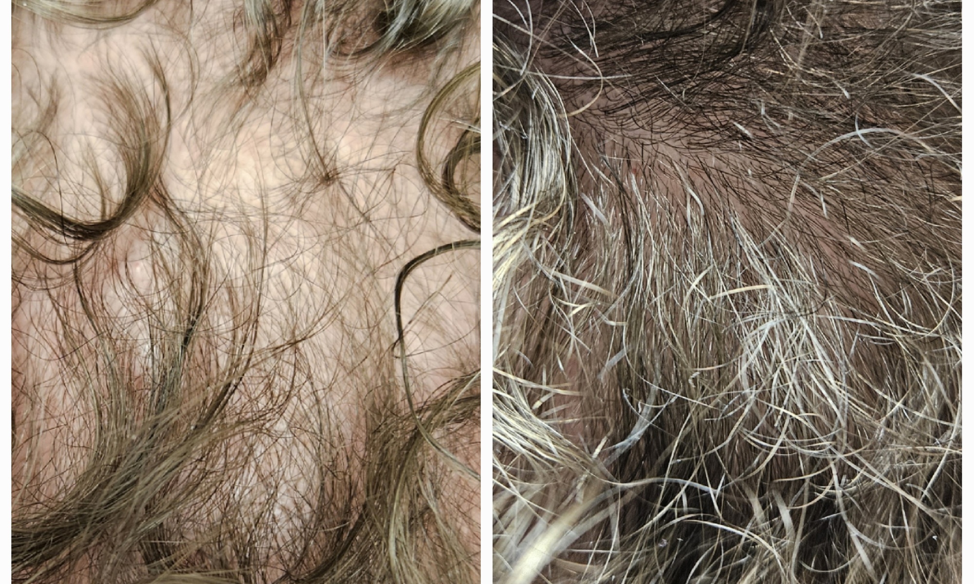 PRP & PRF Consultation and Treatment Options for Hair