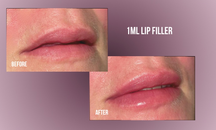 Image 8: Up to 38% Off on Injection - Dermal Filler at Divine Aesthetics Clinic London