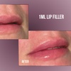 Image 8: Up to 38% Off on Injection - Dermal Filler at Divine Aesthetics Clinic London