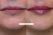Enhance Your Look with Lip, Cheek or Chin Filler or a Russian Lip Flip Treatment (Up to 50% Off) - Second Medium