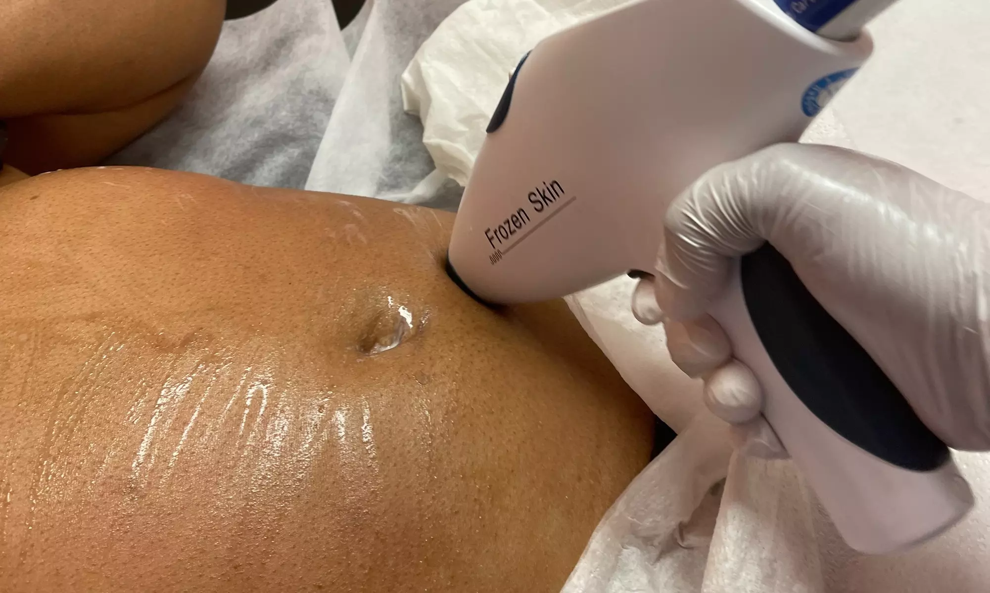 Radio frequency skin-tightening treatment options available