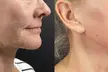 Up to 82% Off for Morpheus8 and Morpheus8 Body Radio-Frequency Skin Tightening at Victoria Med Spa - Second Medium