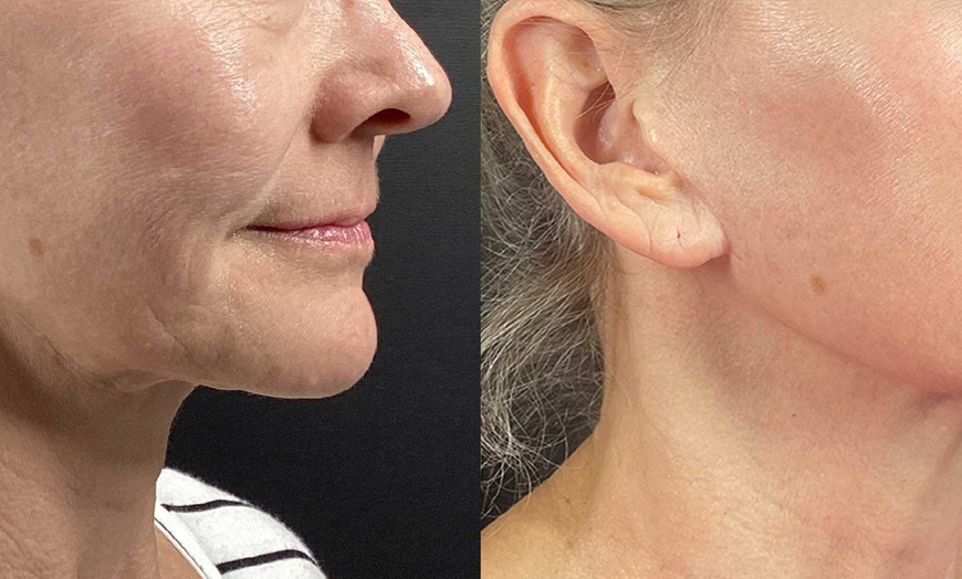 Image 3: Radiant Skin Awaits: Transform with Morpheus8 RF Technology!