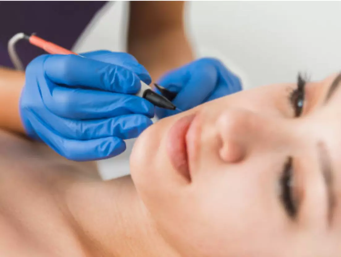 Experience Smoothness with Electrolysis Consultation & 15 mins Session
