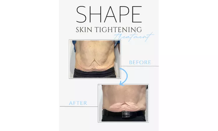 Skin Tightening Packages with Non Surgical Lipo Options