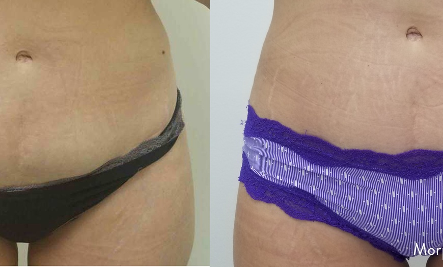 Image 7: Radiant Skin Awaits: Transform with Morpheus8 RF Technology!