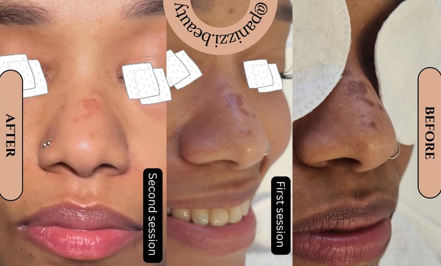 Image 1: 1 or 3 Chemical Peels (Mandelic Peeling) with Optional LED Therapy