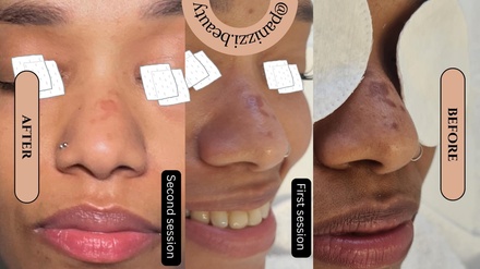 One Session: Chemical Peel (Mandelic Peeling)